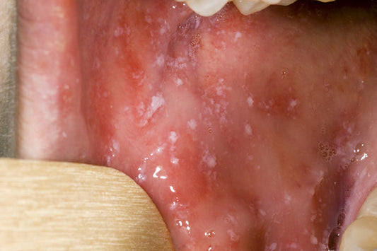 Measles in Australia: What Parents Need to Know in 2025