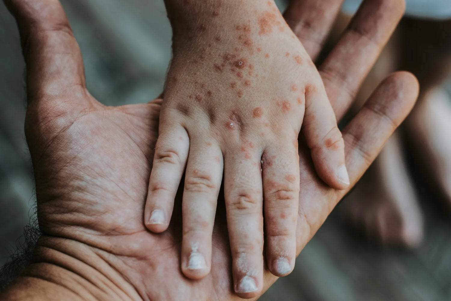 Skin Rash Complete Refrenxe Rash Reference Guide