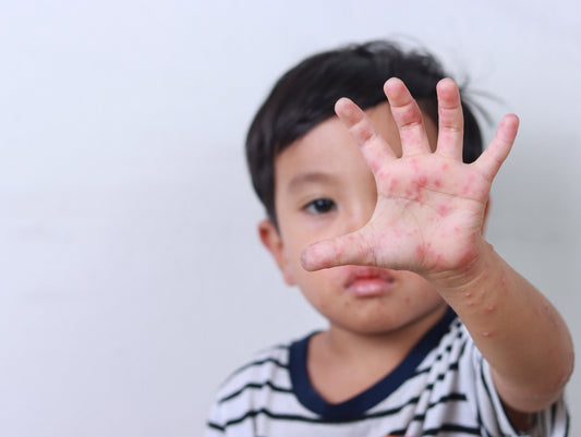 Hand, Foot, and Mouth Disease (HFMD) Guide